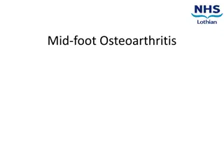 Midfoot Osteoarthritis: Causes, Symptoms, and Management