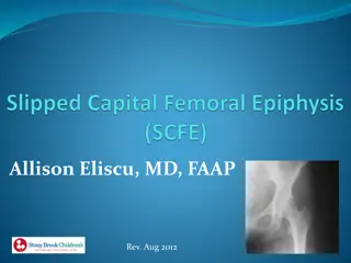 SCFE (Slipped Capital Femoral Epiphysis) in Adolescents