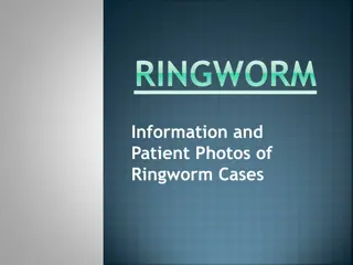 Ringworm: Causes, Types, and Treatment
