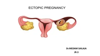Ectopic Pregnancy