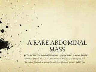 A Rare Abdominal Mass: Clinical Presentation and Diagnosis