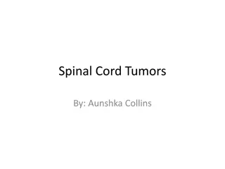 Spinal Cord Tumors Overview