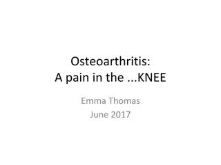 Glucosamine for Knee Osteoarthritis