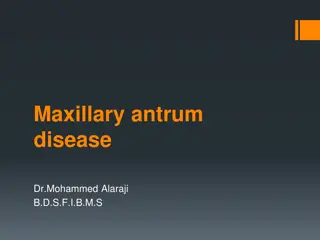 Maxillary Sinus Disease