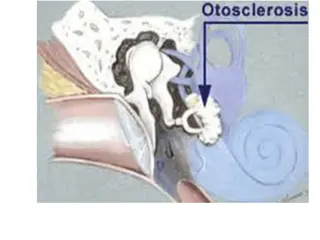 Otosclerosis in Adults: Causes and Symptoms
