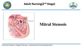 Mitral Stenosis - Symptoms and Pathophysiology Overview