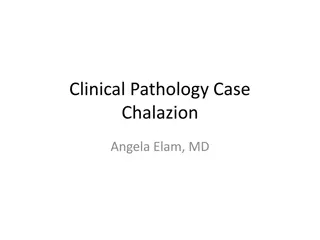 Chalazion: Clinical Features and Pathophysiology