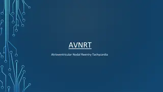 AVNRT: Atrioventricular Nodal Reentry Tachycardia Explanation