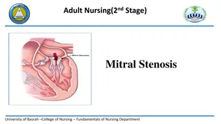 Mitral Stenosis: Causes, Symptoms & Pathophysiology