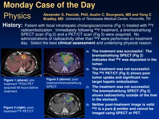 Successful 90Y Radioembolization Case Study Analysis