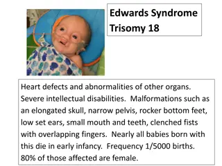 Genetic Disorders Overview: Trisomies & Monosomy in Human Genetics
