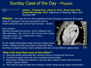 Artifacts in ECG-Gated Chest CT Angiogram