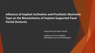 Implant Inclination Influence on Biomechanics of Fixed Dentures