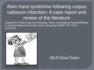 Alien Hand Syndrome: Case Report and Review of Literature