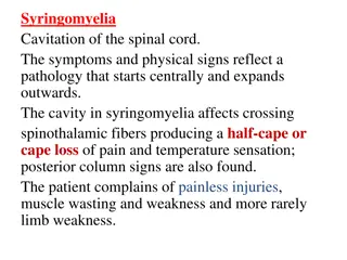 Syringomyelia, Brown-Séquard Syndrome, and Motor Neuron Disease