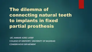 Connecting Natural Teeth to Implants in Fixed Partial Prosthesis Dilemma