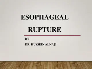 Esophageal Rupture: Causes, Symptoms, and Treatment