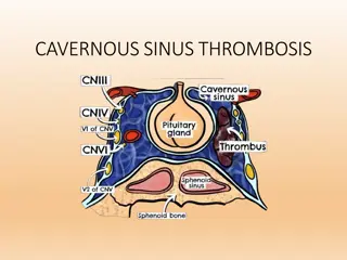 Understanding Cavernous Sinus Anatomy and Thrombosis