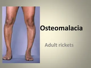 Osteomalacia in Adults: Causes, Symptoms & Management