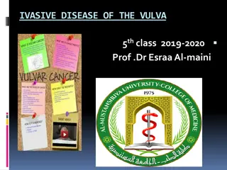 Invasive Disease of the Vulva: Symptoms, Treatment, and Prognosis