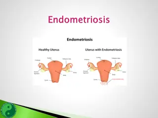 Endometriosis: Symptoms, Causes, and Treatment