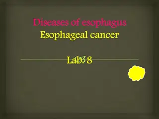 Overview of Esophageal Cancer: Symptoms, Causes, and Types