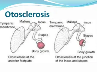 Otosclerosis: Causes, Symptoms, and Diagnosis