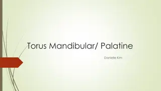 Torus Mandibularis and Torus Palatinus: Etiology and Impacts