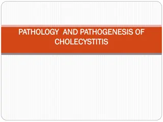 Understanding Cholecystitis and Gallstones: Causes and Risk Factors