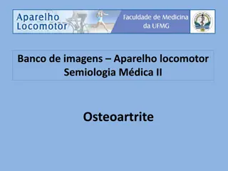 Understanding Osteoarthritis: Symptoms and Radiographic Findings