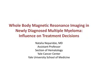Influence of Whole Body MRI on Multiple Myeloma Treatment Decisions
