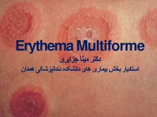 Understanding Erythema Multiforme: Symptoms, Causes & Treatment