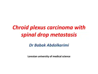 Choroid Plexus Carcinoma with Spinal Drop Metastasis Overview