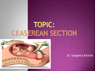 Understanding Cesarean Section Procedure