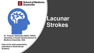 Understanding Lacunar Strokes and Infarcts
