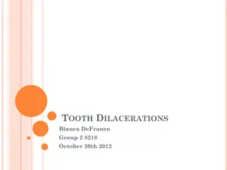 Tooth Dilacerations: Causes, Complications, Treatment