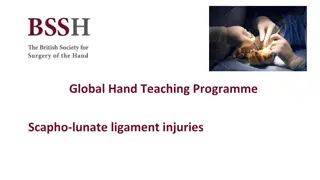 Understanding Scapho-lunate Ligament Injuries