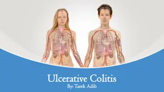 Understanding Ulcerative Colitis: Symptoms, Diagnosis, and Treatment