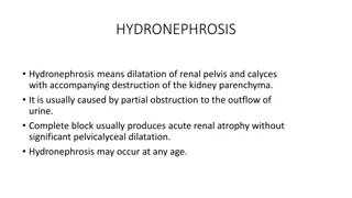 Understanding Hydronephrosis: Causes and Characteristics