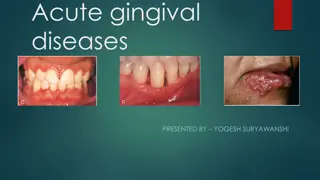 Overview of Acute Gingival Diseases