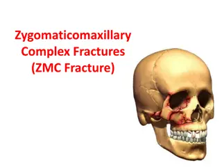 Understanding Zygomaticomaxillary Complex Fractures